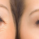 Can Blepharoplasty Surgery Fix Vision Problems As Well?